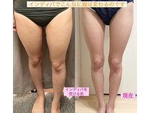 リリィ(lily)/悩みの脚が自慢の美脚に