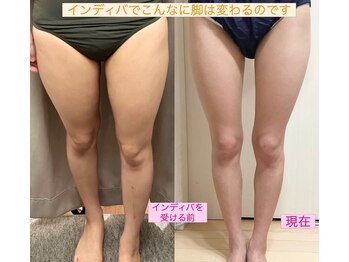 リリィ(lily)/悩みの脚が自慢の美脚に