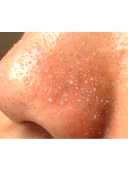 毛穴ケアをしたい