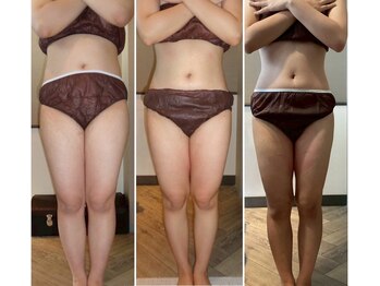 フォビィサロン(FOBE...salon)/冷却痩身