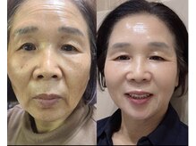 ICDスキンスタジオ 新宿三丁目(ICD-skin studio)/Before-After