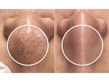 ワイスタイル(Ystyle)/毛穴洗浄×ホームケア