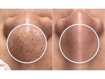 ワイスタイル(Ystyle)/毛穴洗浄×ホームケア