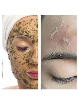 サロンハル(salon HARU)の写真/本気の肌質改善！剥けるハーブピーリングでつるつる肌へ☆ニキビ肌、背中、腕、お尻にも徹底アプローチ♪