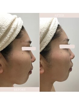 ブリス(Bliss)/リアボーテハーブトリートメント