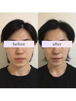 小顔革命 小顔 全身美容矯正専門店/小顔矯正+超音波リフトアップ