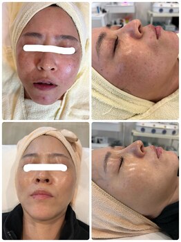 ラウレア(Laule'a)/シミケア!ピグメンテーション