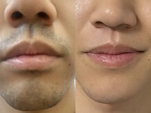 スタジオサンハチゴ(studio-385)/【ひげ脱毛】人気NO.1メニュー