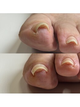 リリ(lili)/巻き爪矯正/1回目