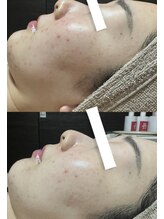 フィール(feel)/ビフォー　アフター3回施術