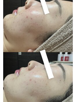 フィール(feel)/ビフォー アフター3回施術