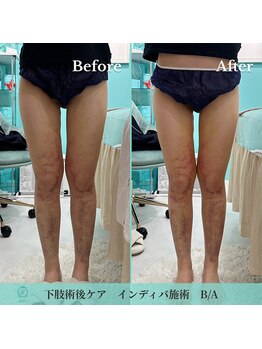 ノット(KNOT)/下肢ダウンタイムBefore/After