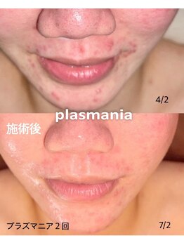 アールスタイルビューティ(R STYLE BEAUTY)/プラズマハ-ブピ-リング赤ニキビ