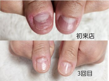 グラシナ なんば店/深爪/自爪育成/フィルイン
