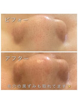 ヴィオナス(Veonus)/毛穴の黒ずみもキレイ