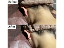 ビマナ 小岩店(NU美Mana)/【うなじ脱毛】