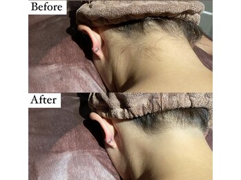 ビマナ 小岩店(NU美Mana)/【うなじ脱毛】