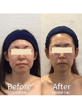 小顔フェイスラボ 瀬田店(小顔 Face Labo.)/小顔＆整体コルギの変化