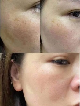 シャンディール(Shandeel)/光フェイシャル、IPL照射