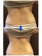 ディープブルー(Deep blue)/痩身キャビテーション