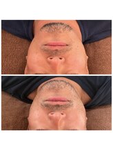 ノフ 恵比寿(noff)/メンズ漢鍼（美容鍼＋頭皮鍼）