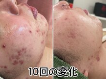 アミュレット(Amulette)の雰囲気（お客さま一人一人に合ったオーダーメイドプランをご提案◎[毛穴]）