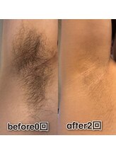 ボウイズ 磐田店(BOYZ)/ワキ脱毛　2回　before after