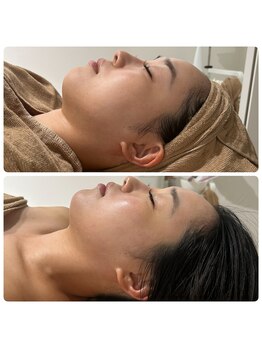 シンスプラス(SINCE+)/１回の変化、小顔コース、むくみ