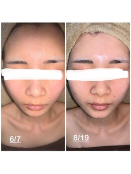 ミニョン(mignon)/モニター結果