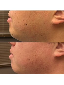 フェリーバ(FELIVA)/青髭消してお肌もちもちへ