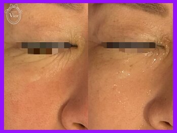 ハーブピーリング 名古屋/ケアが難しい目元にも可能＊