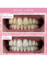 エクシアホワイトニング 四日市店/ホワイトニングビフォーアフター
