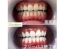 ルブラン 奈良店(Le Blanc)/ホワイトニングで好印象