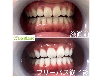 ルブラン 奈良店(Le Blanc)/ホワイトニングで好印象