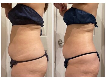 ルナグランデ(Luna grande.)/脂肪分解 3回で…!!