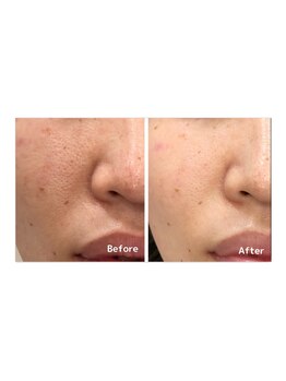 アンドエピ(&epi)/ハイドロヴィーナス症例写真3