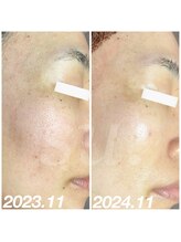 スウ(su:)/毛穴が消えた！？