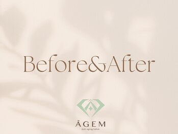 アージェム(AGEM)/Before&After
