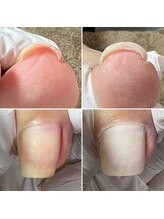 ルーチェ バイ フェリシア(LUCE by Felicia)/【巻き爪】アクリル使用