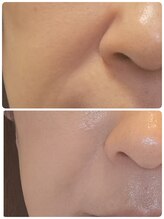 ロゼブランシュ(Rose Blanche)/最新！【小顔/リフトアップ】