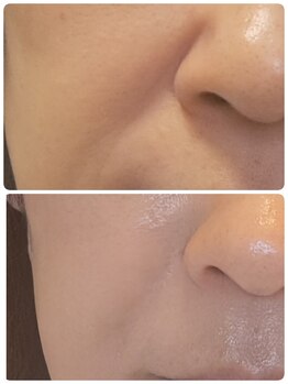 ロゼブランシュ(Rose Blanche)/最新!【小顔/リフトアップ】