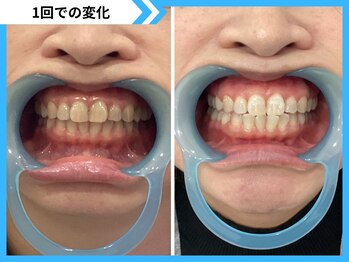 鹿児島ホワイトニング/Before→After