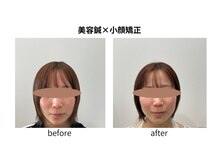 ブライト鍼灸整体院(Bright鍼灸整体院)/美容鍼×小顔矯正