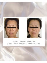 エテル(eter)/エクスビアンPHA水光ピール