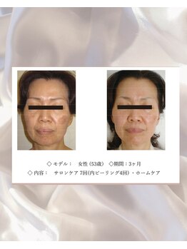 エテル(eter)/エクスビアンPHA水光ピール