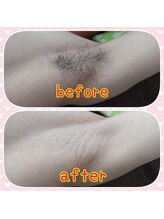スマイルボディ つぼの森 伊集院店(Smile body)/☆メンズ/わき脱毛☆