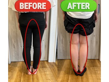 スロース鍼灸整体院(SLOTH鍼灸整体院)/О脚の改善例