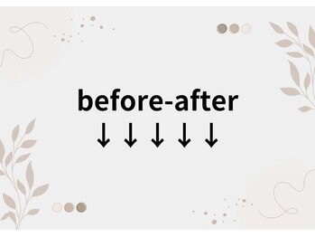 巻き爪矯正before-after