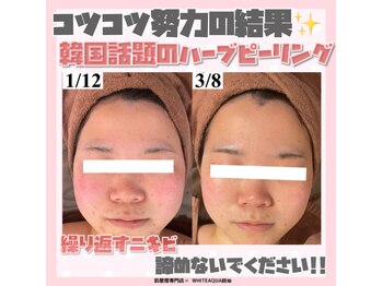 ホワイトアクア 岐阜店(WHITE AQUA)/ハーブピーリング/岐阜/ニキビ