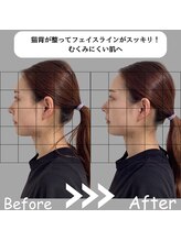 ゆしんアネックス/美容鍼のビフォーアフター☆